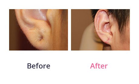 Earlobe-Rapair-img-2