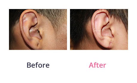 Earlobe-Rapair-img-3
