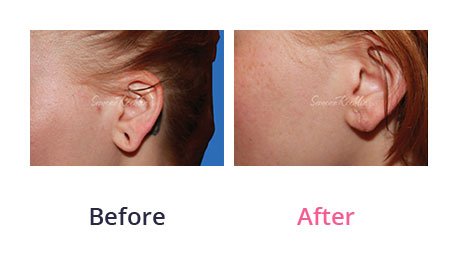Earlobe-Rapair-img-4