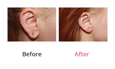 Earlobe-Rapair-img-5