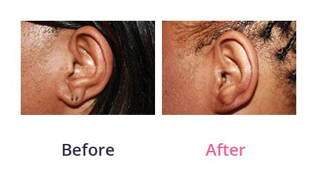 Earlobe-Rapair-img-6