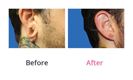 Earlobe-Rapair-img-7
