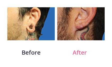 Earlobe-Rapair-img-8