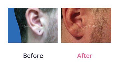 Earlobe-Rapair-img-9