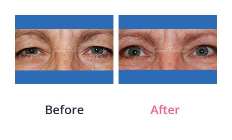 Eyelid-Surgery-img-1