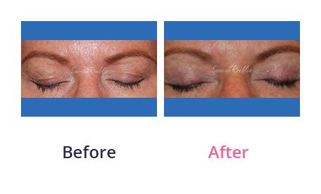 Eyelid-Surgery-img-10