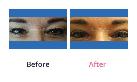 Eyelid-Surgery-img-11