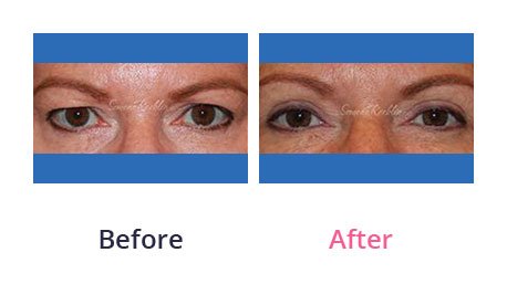 Eyelid-Surgery-img-12