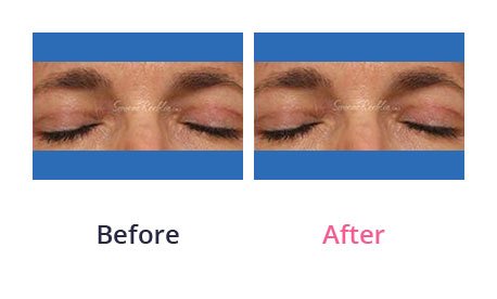 Eyelid-Surgery-img-13