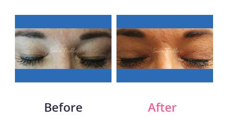 Eyelid-Surgery-img-14