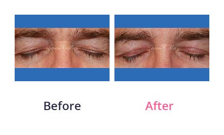 Eyelid-Surgery-img-15