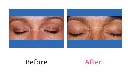 Eyelid-Surgery-img-16