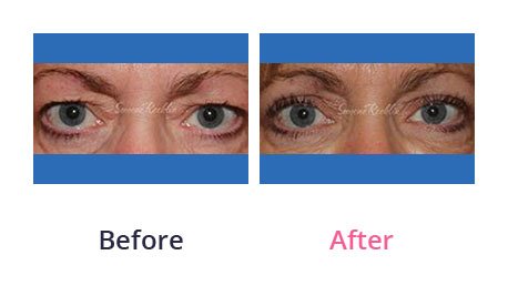 Eyelid-Surgery-img-17