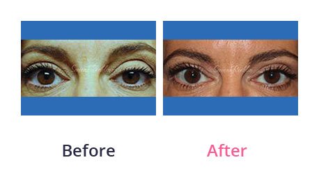 Eyelid-Surgery-img-18