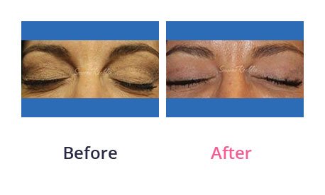 Eyelid-Surgery-img-19