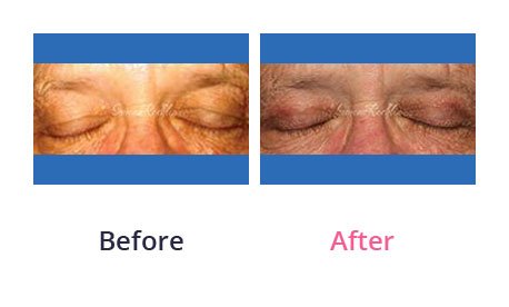 Eyelid-Surgery-img-2
