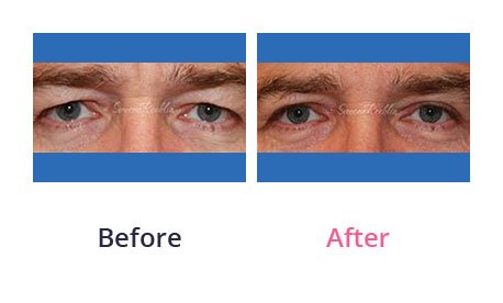Eyelid-Surgery-img-20