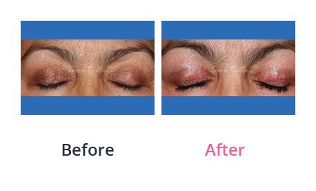 Eyelid-Surgery-img-21