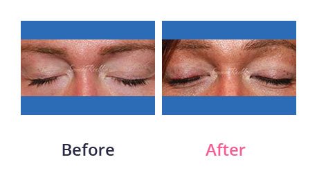 Eyelid-Surgery-img-22