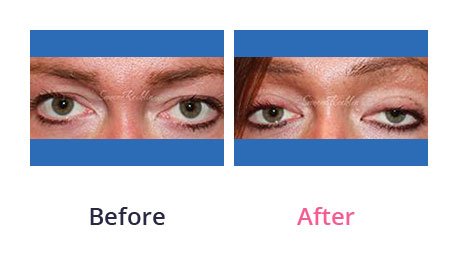 Eyelid-Surgery-img-23