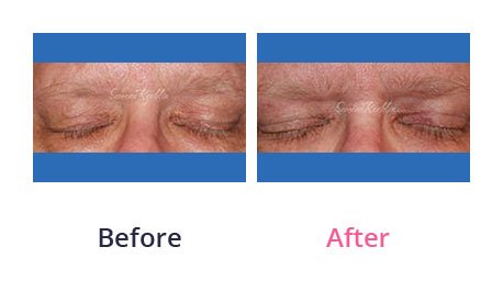 Eyelid-Surgery-img-24