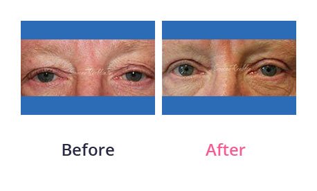 Eyelid-Surgery-img-25