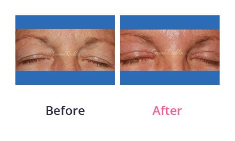Eyelid-Surgery-img-26