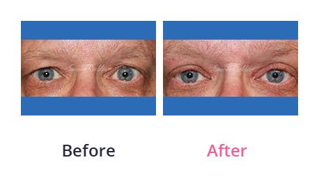 Eyelid-Surgery-img-27
