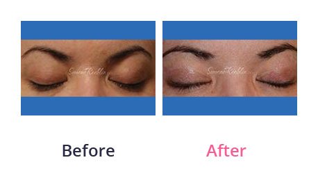 Eyelid-Surgery-img-28
