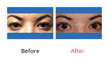 Eyelid-Surgery-img-29
