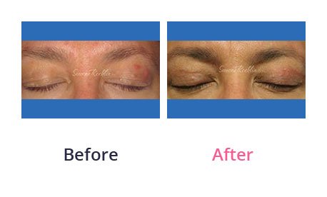 Eyelid-Surgery-img-3