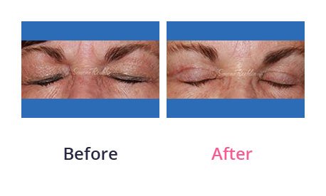 Eyelid-Surgery-img-30