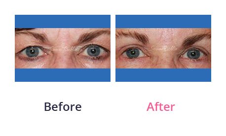 Eyelid-Surgery-img-31