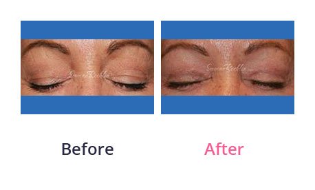 Eyelid-Surgery-img-32