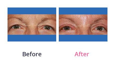 Eyelid-Surgery-img-33