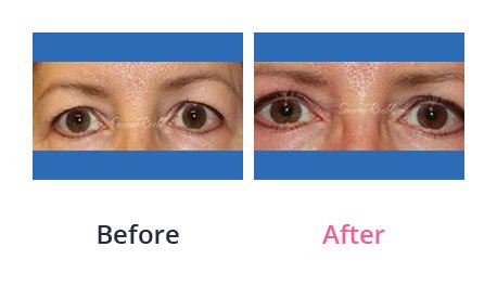 Eyelid-Surgery-img-34