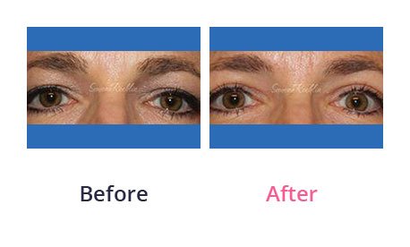 Eyelid-Surgery-img-35