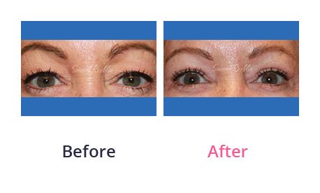 Eyelid-Surgery-img-36