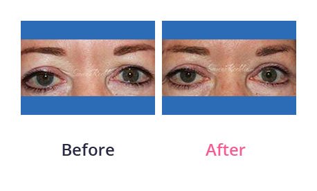 Eyelid-Surgery-img-37