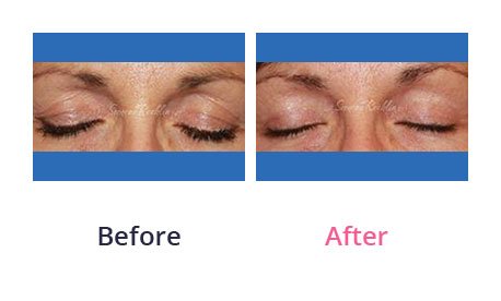 Eyelid-Surgery-img-38