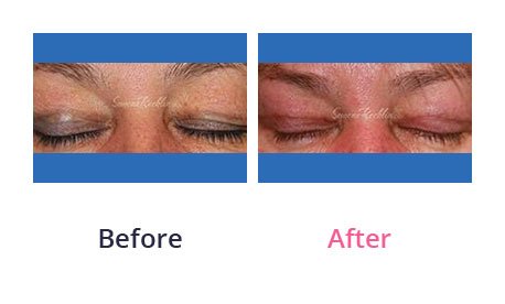 Eyelid-Surgery-img-4