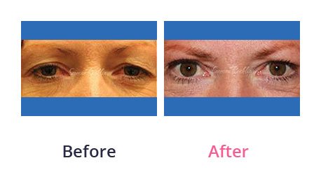 Eyelid-Surgery-img-40