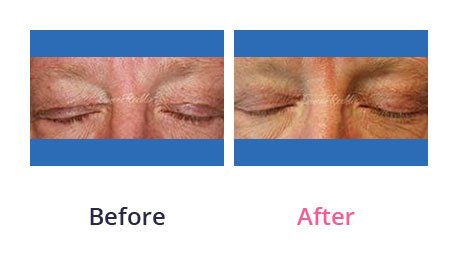 Eyelid-Surgery-img-41