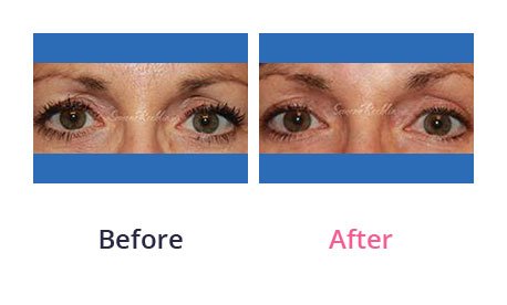 Eyelid-Surgery-img-42