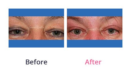 Eyelid-Surgery-img-43