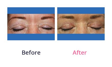 Eyelid-Surgery-img-44