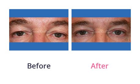 Eyelid-Surgery-img-45
