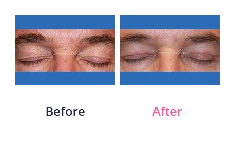 Eyelid-Surgery-img-47