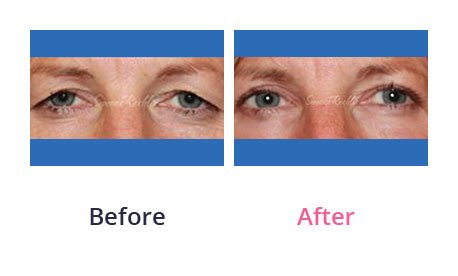 Eyelid-Surgery-img-48