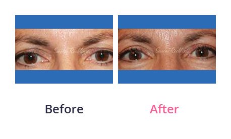 Eyelid-Surgery-img-49